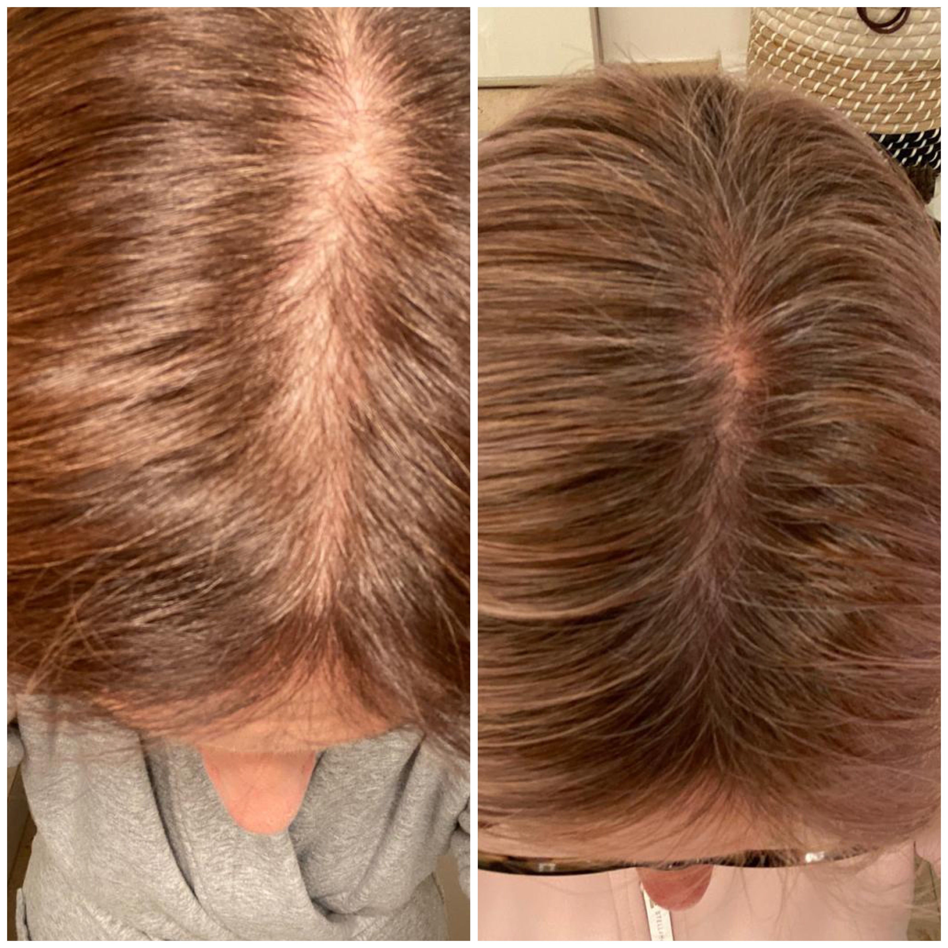 vorher-nachher-dichterer-haaransatz-mit-harvekst-hair-serum