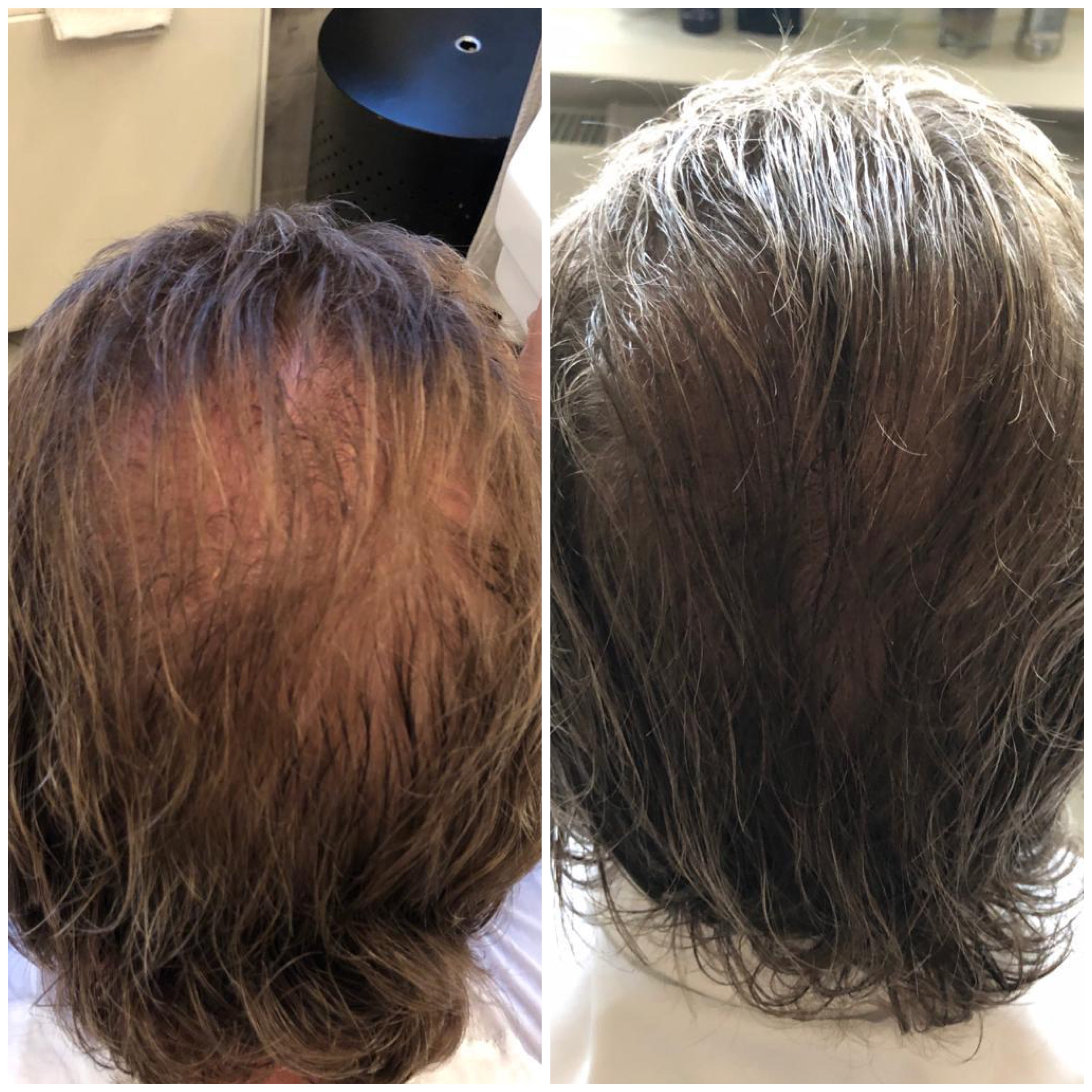 vorher-nachher-rezession-leichte-glatzenbildung-verbessert-mit-harvekst