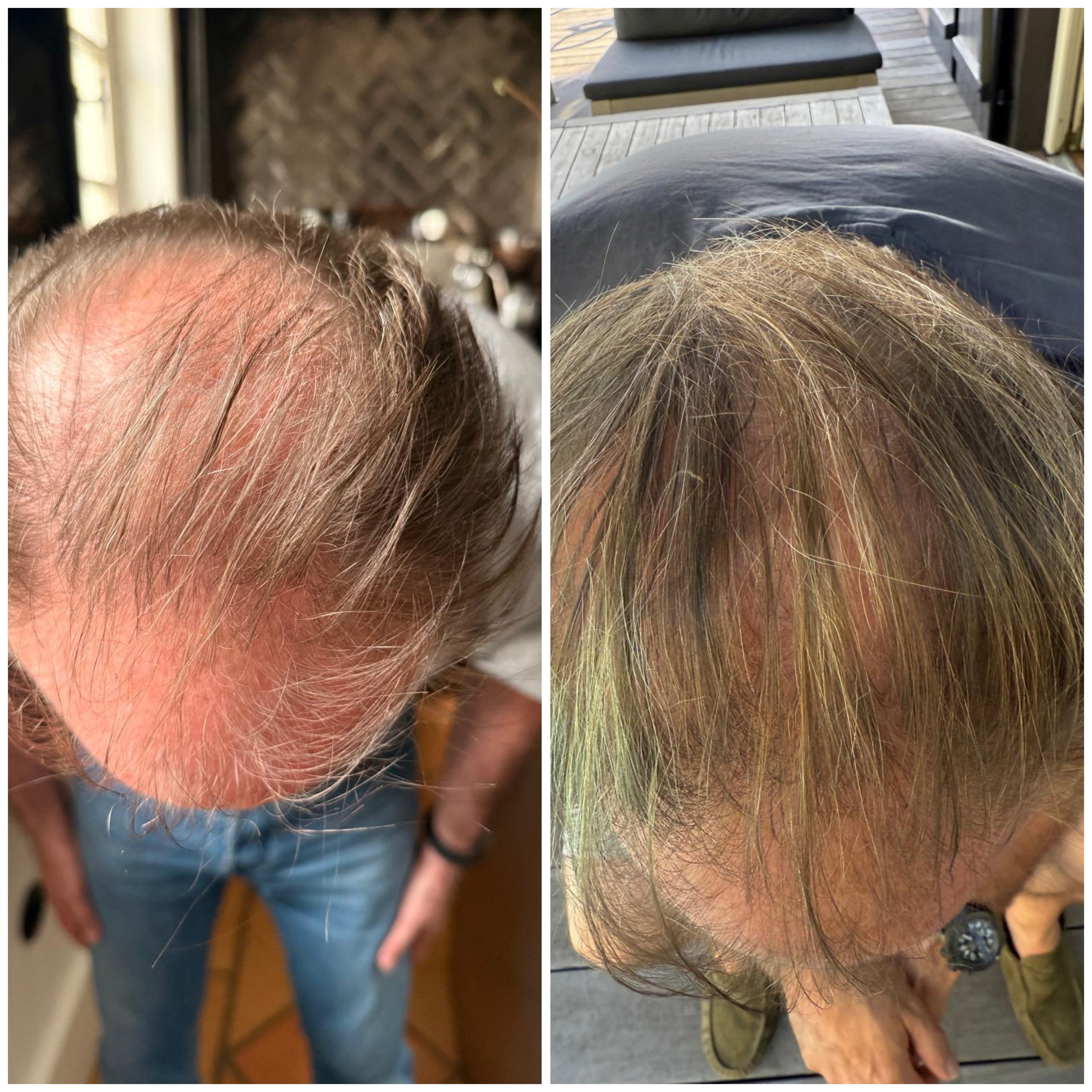 vorher-nachher-neue-haare-und-feiner-neuwuchs-mit-harvekst