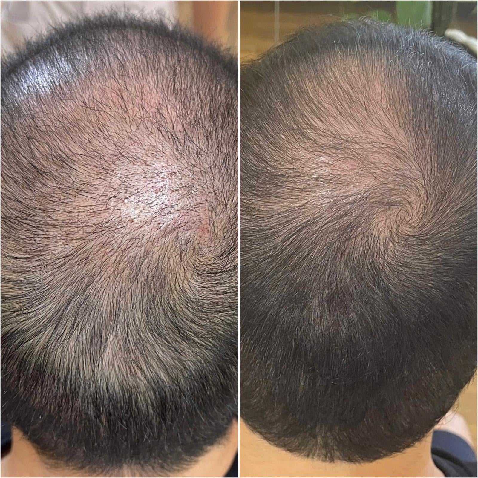 vorher-nachher-haarwachstum-harvekst-hair-serum-ergebnis-nach-wochen